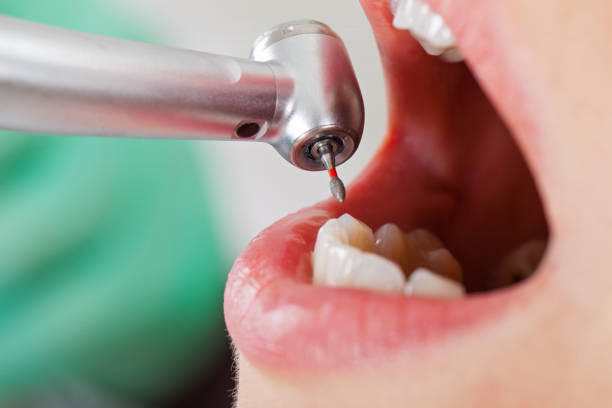 Best Emergency Dentist for Knocked-Out Tooth in Jacksonville, OR